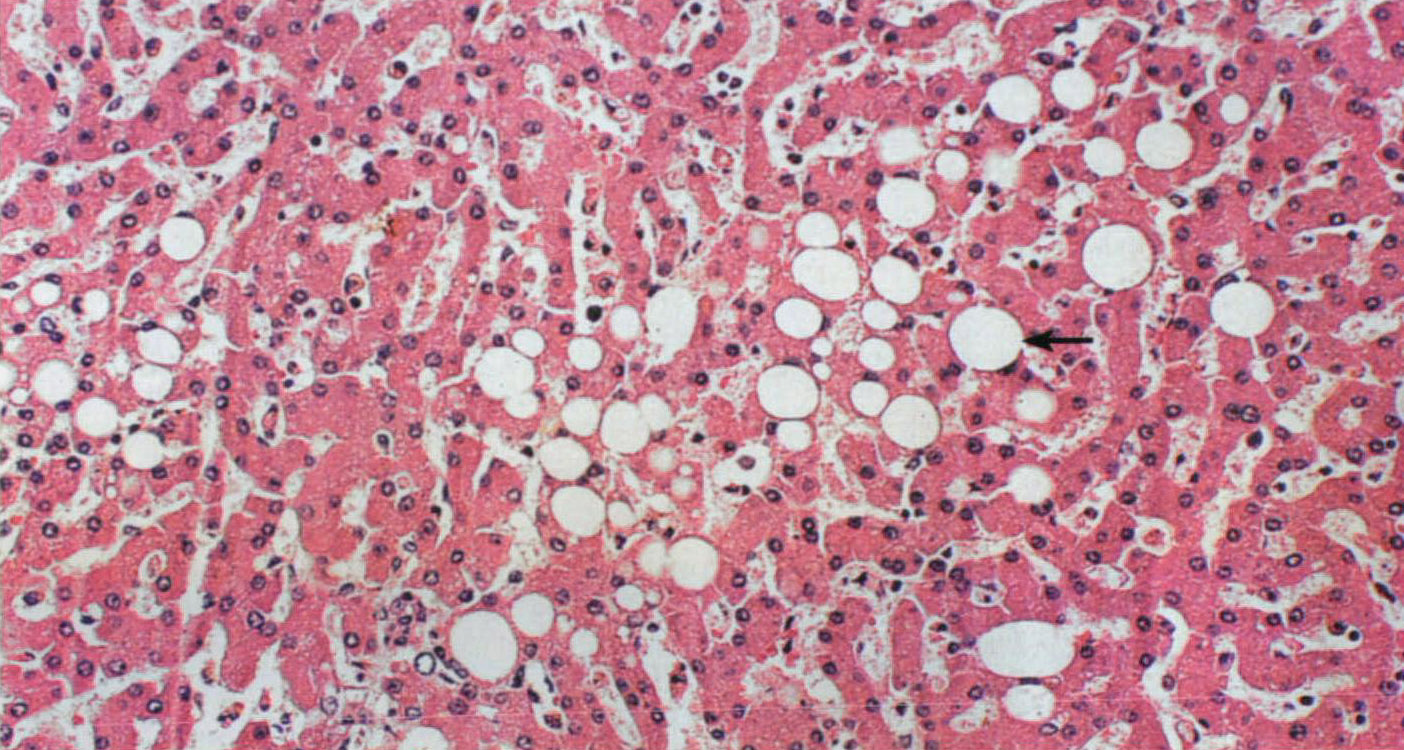 图2 肝细胞脂肪变性